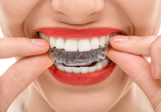 Clareamento dental em Londrina - Estética. Clínica Odontológica oferece diversos tratamentos estéticos para clarear os dentes na cidade de Londrina.