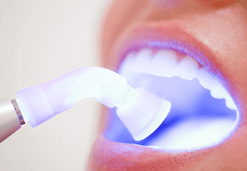 Dentística - estética - restauração de dente em Londrina. Oferecemos diversos métodos restauradores, com materiais de excelência. Dentista em Londrina - Restauração Dentária